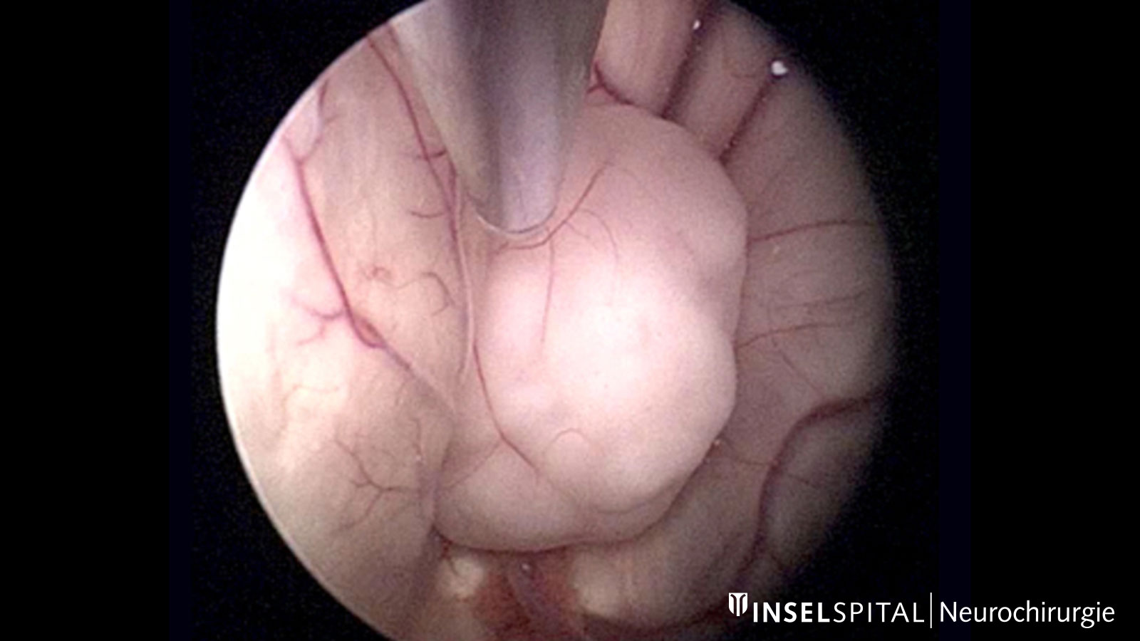 Full endoscopic removal of a subependymoma in the lateral ventricle