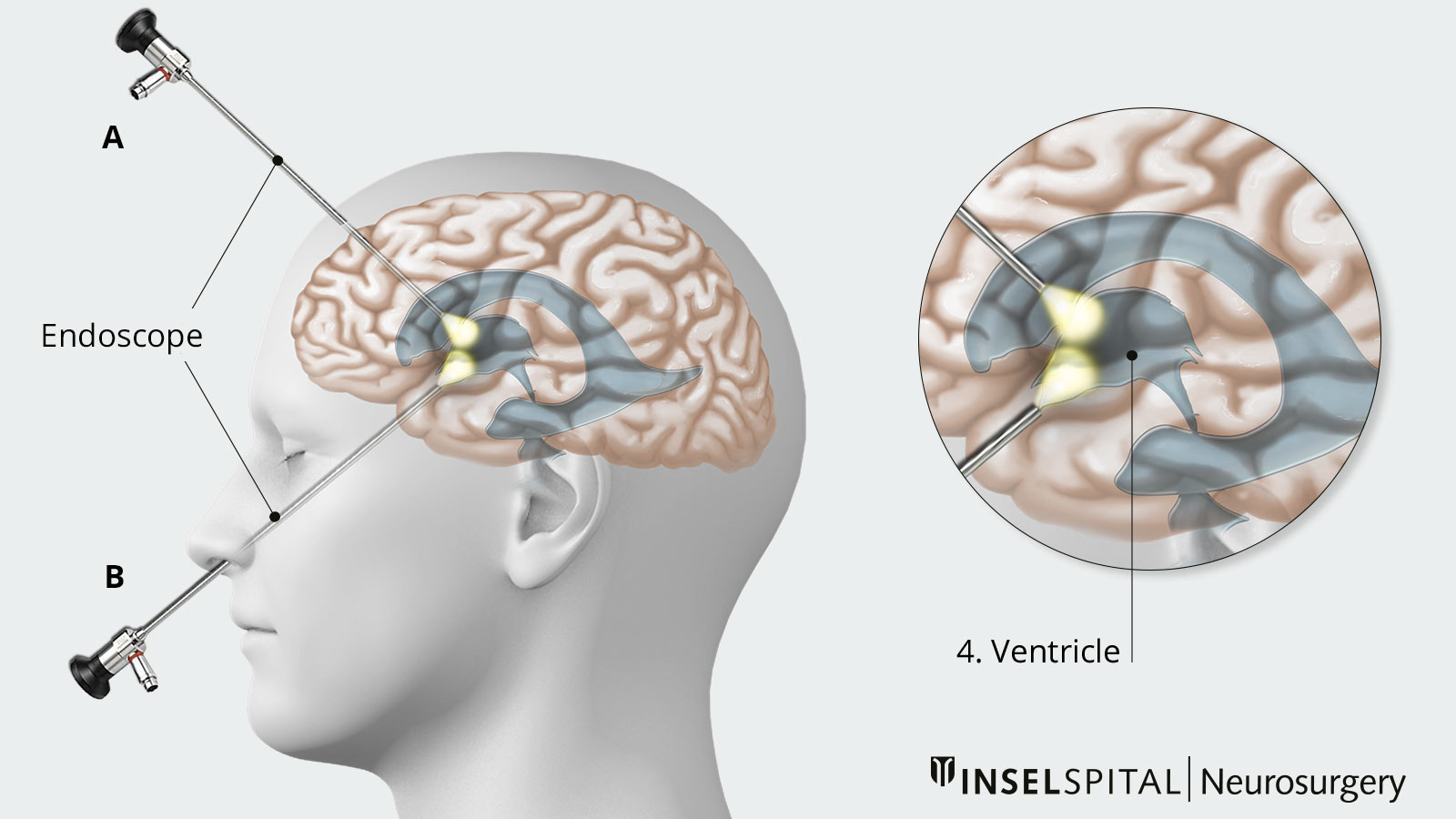 Drawing showing transcranial access to the ventricular system and transnasal access to the skull base