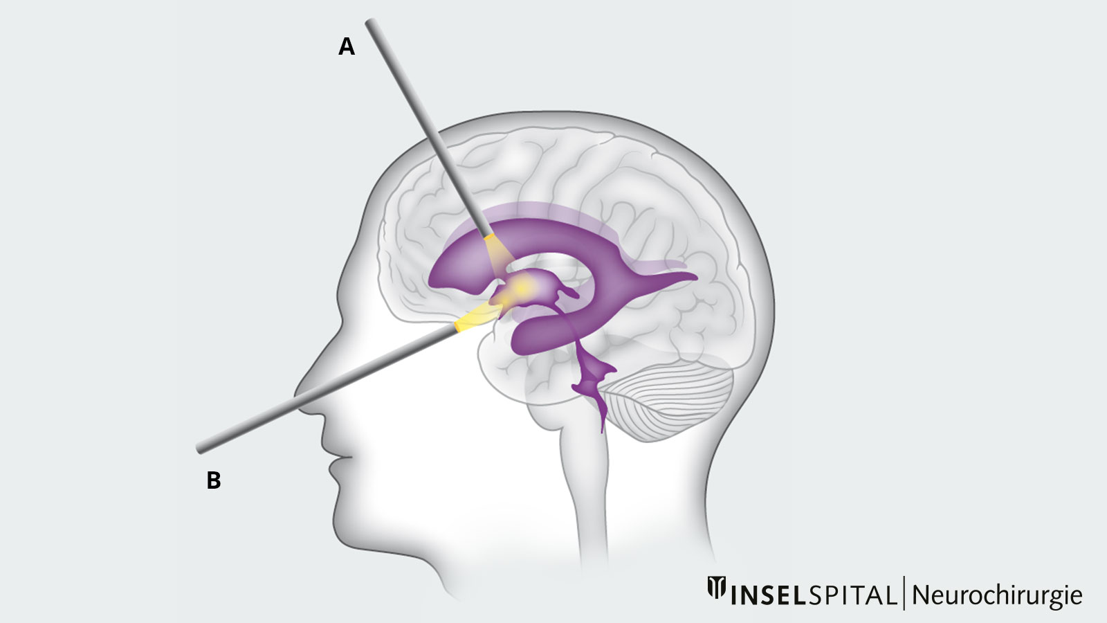 Drawing of transcranial access to the ventricular system and transnasal access to the base of the skull