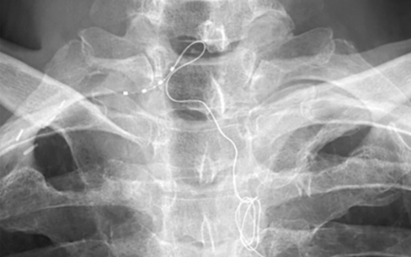 X-ray image of the applied electrodes