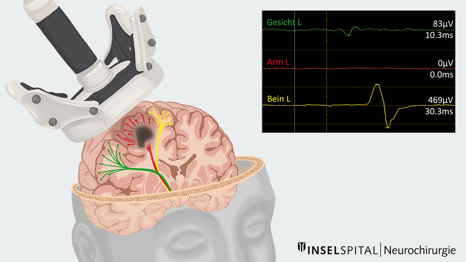 ​Zeichnung einer TMS-Ableitung von Gesicht, Arm und Bein