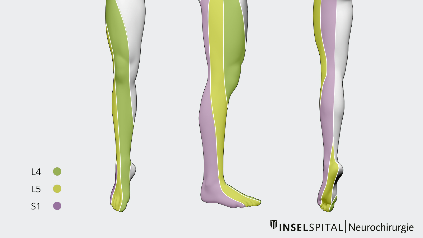 Drawing of the dermatomes on the leg after lumbar disc herniation