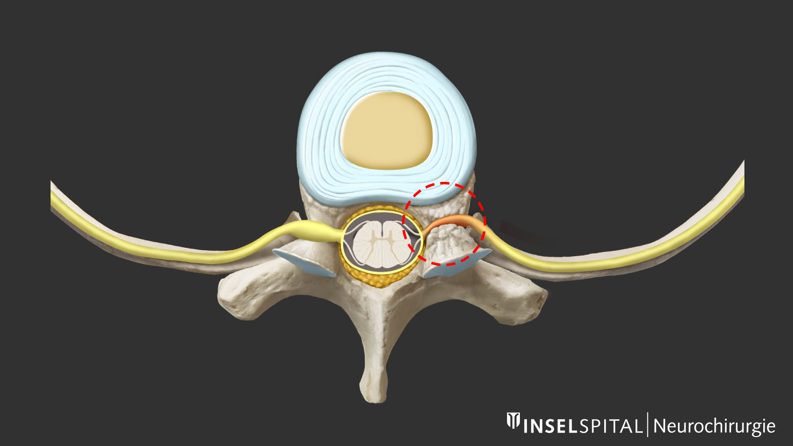 Drawing of a foraminal stenosis. Nerve compression marked in red.