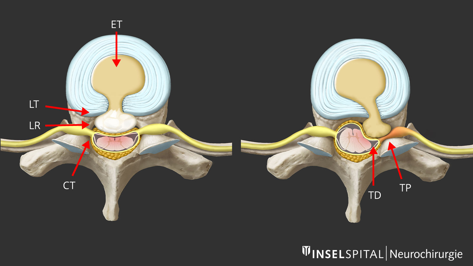 ​2 dessins des 6 voies d'accès possibles pour les hernies discales dures, calcifiées et molles du rachis thoracique.