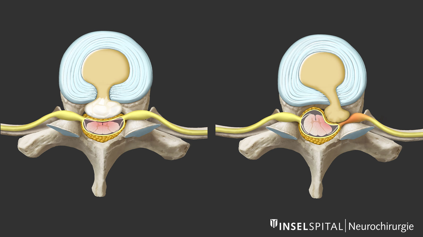 2 drawings of thoracic disc herniation: hard and calcified on the left, soft on the right.