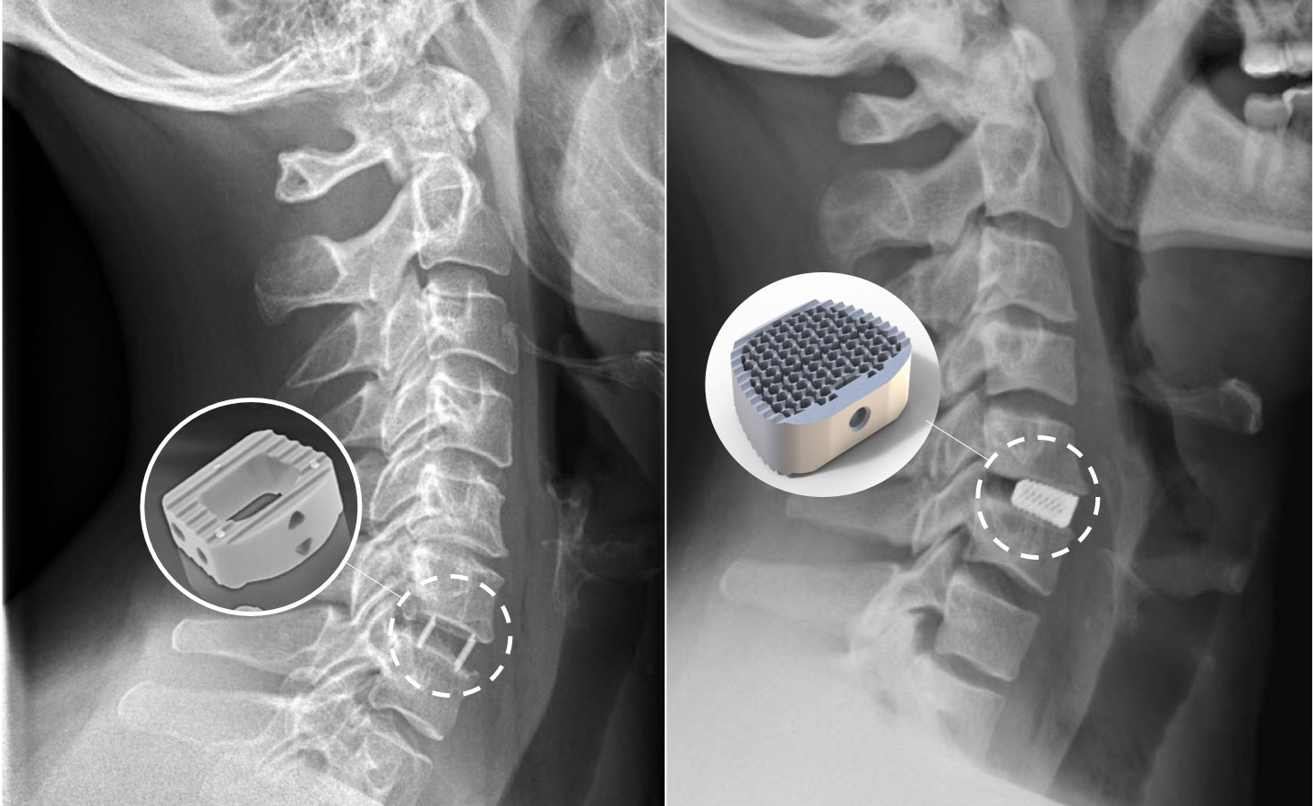 ​MRI images with superimposed plastic or titanium cages