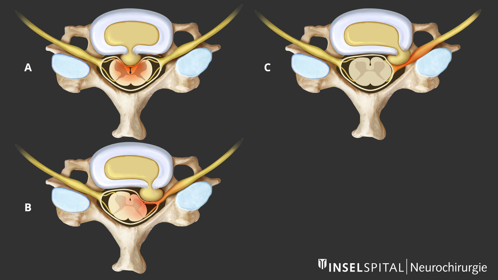 Dessin de 3 hernies discales positionnées différemment avec une compression différente correspondante