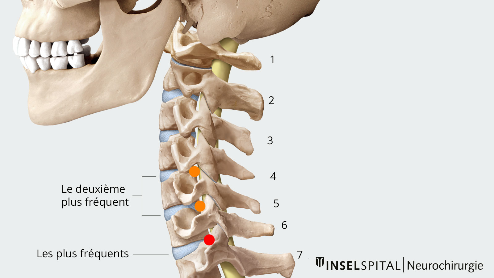 Dessin de la colonne cervicale avec marquage des vertèbres cervicales où les incidents se produisent le plus souvent