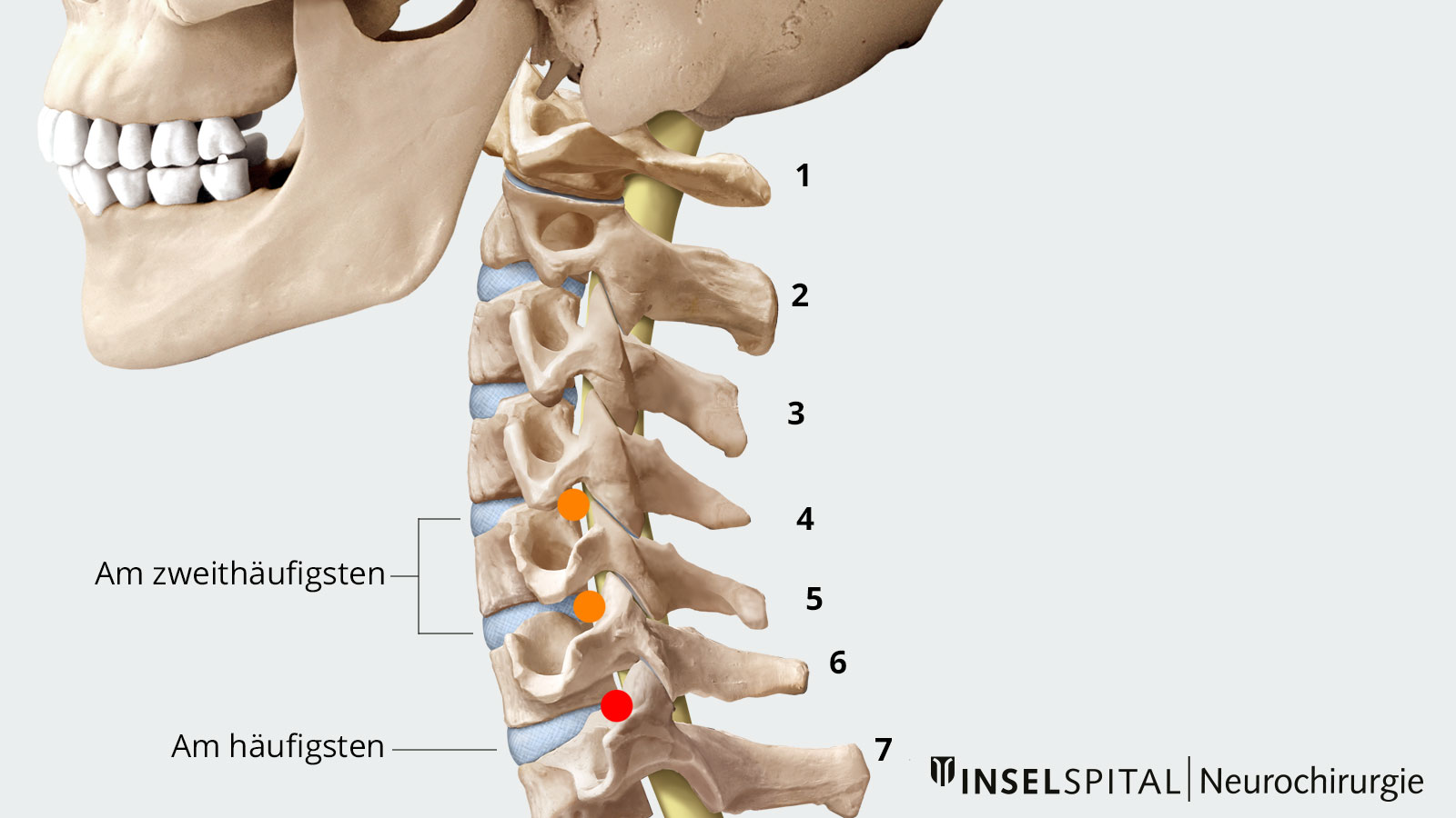 ​Zeichnung der Halswirbelsäule mit Markierung der Halslwirbel, wo Vorfälle am häufigsten auftreten