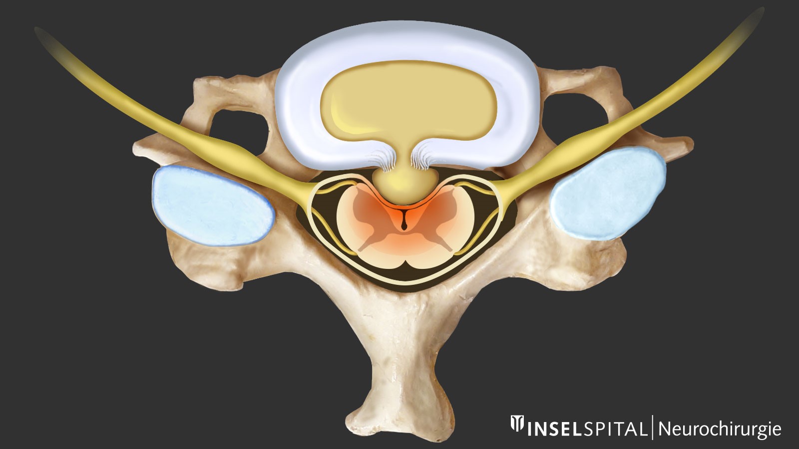 Drawing of spinal cord compression after disc herniation