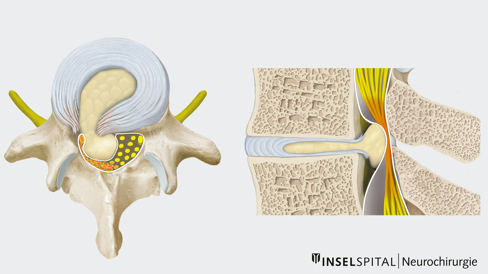 Drawing of a lumbar disc herniation with nerve compression