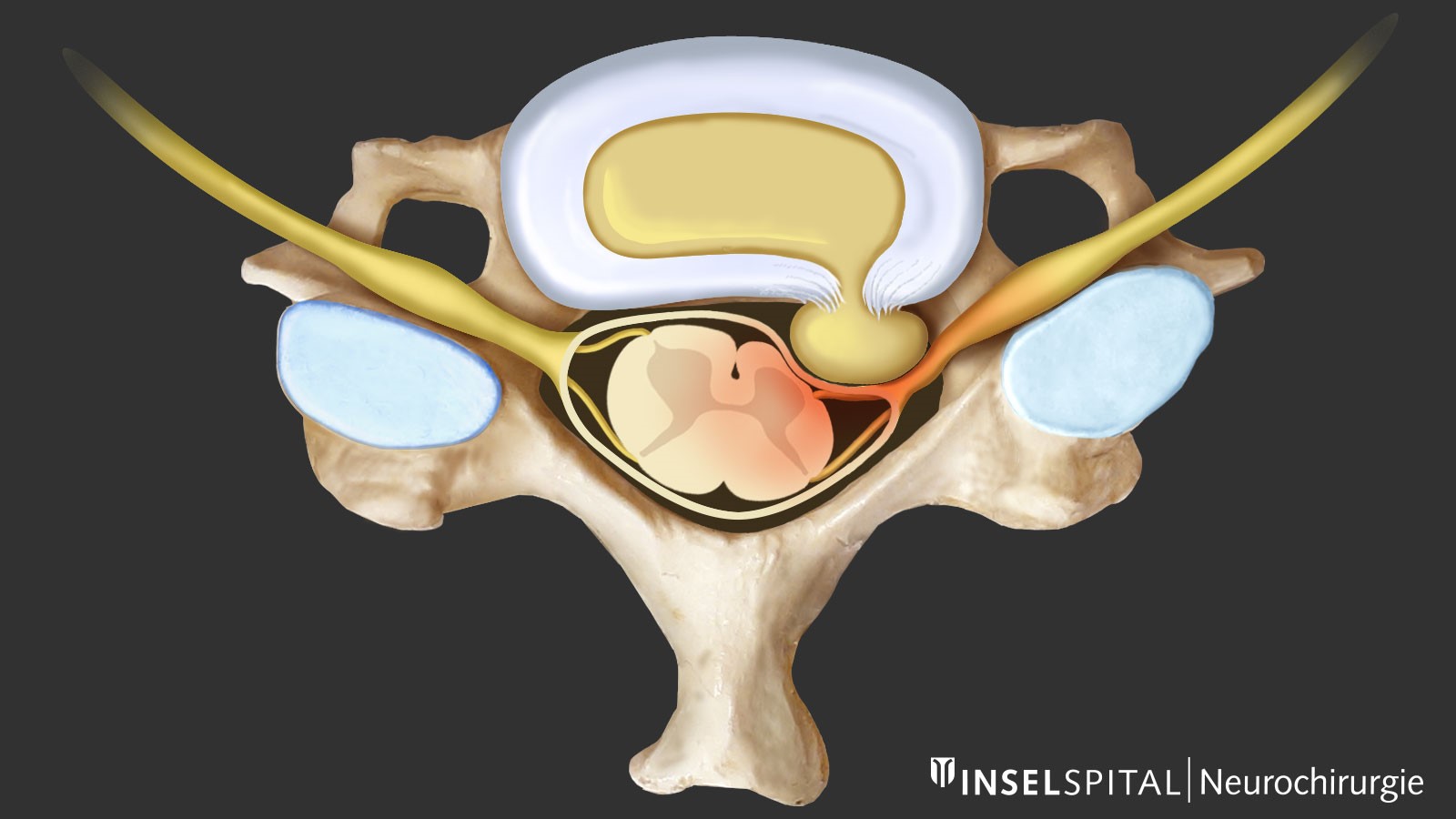 Dessin en couleur d'une hernie discale de la colonne cervicale avec compression de la moelle épinière