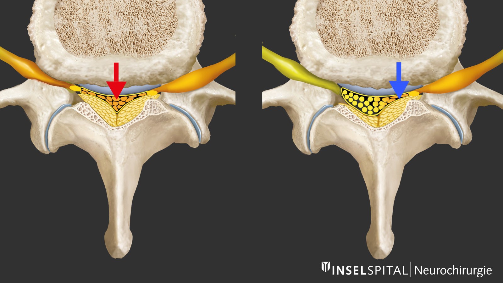 Drawing visualizing the possible locations of a stenosis (in the middle or at the edge of the spinal canal)