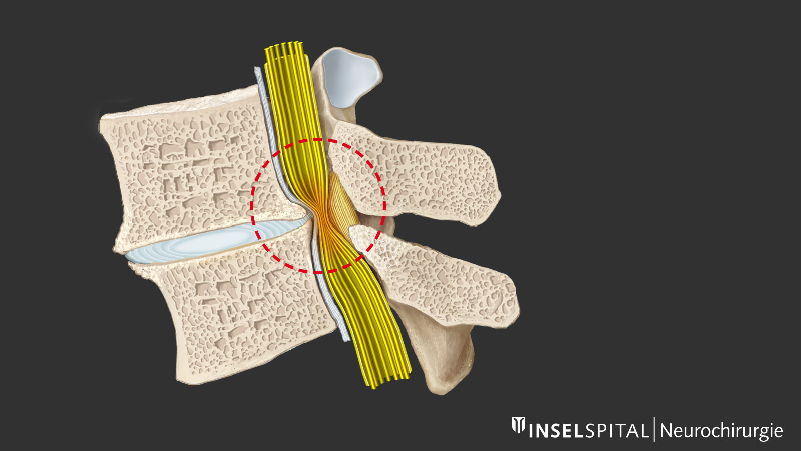 ​Drawing of a spinal canal stenosis