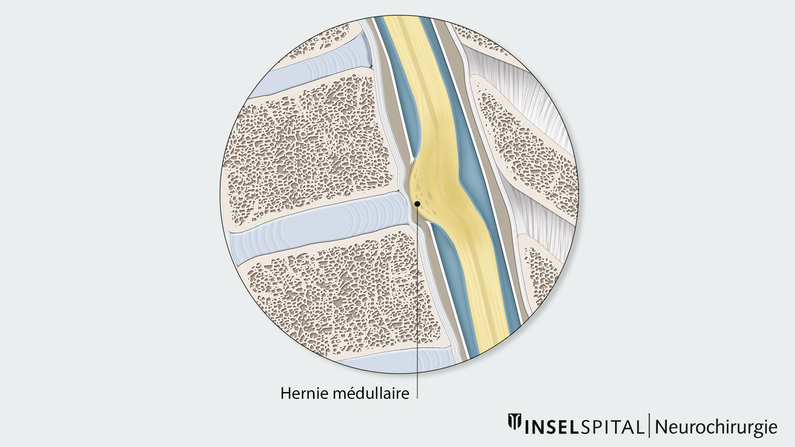 Dessin d'une hernie médullaire en vue latérale