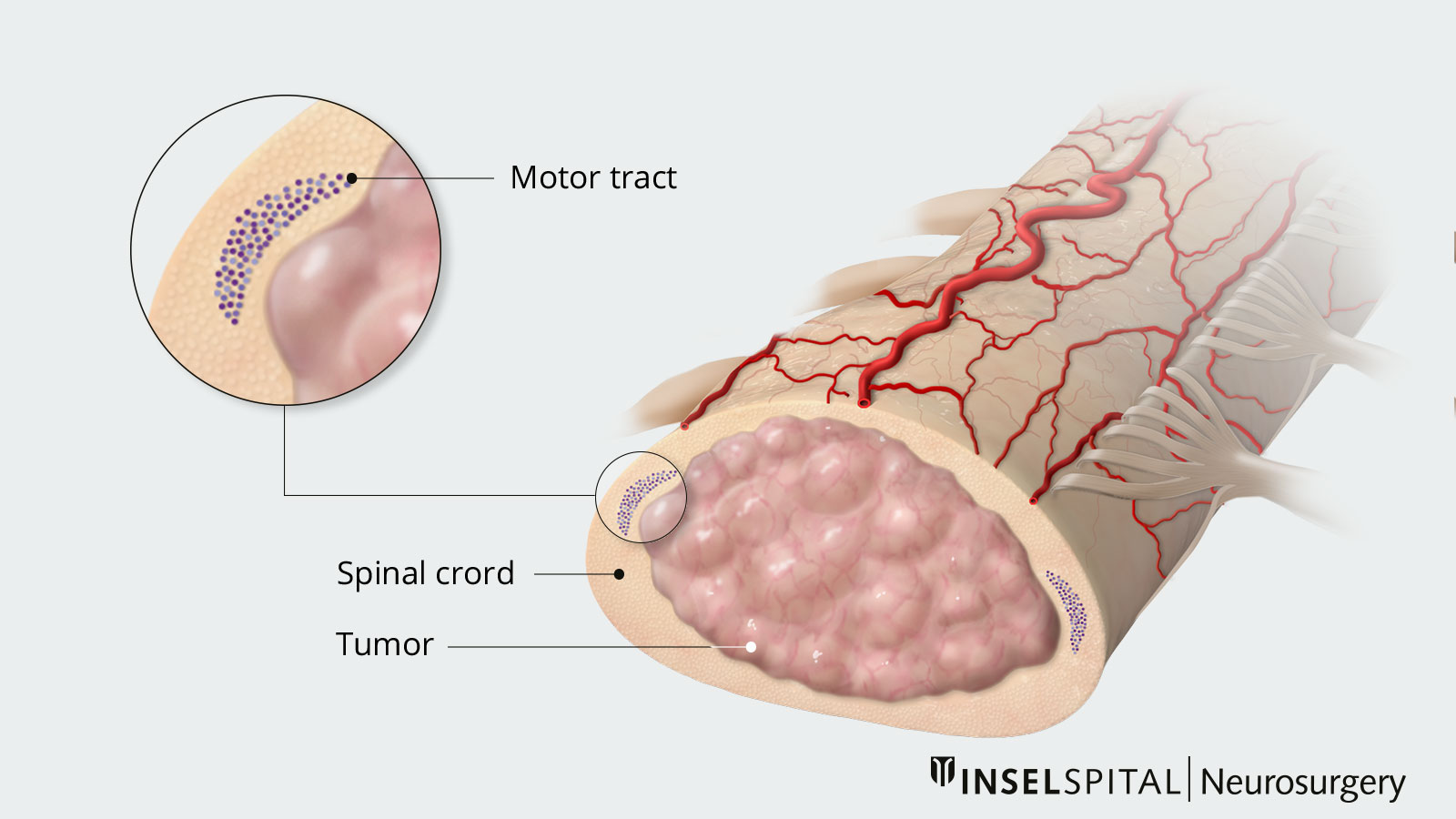 Drawing of an intramedullary ependymoma displacing the spinal cord and pressing on the motor pathway.