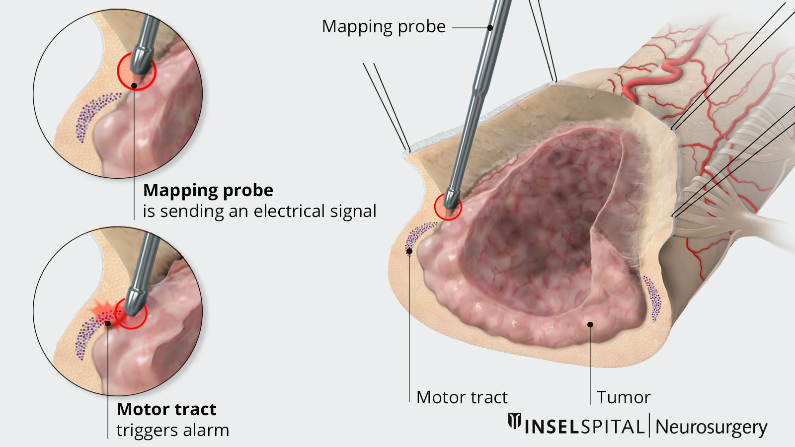 Representation of mapping in 3 part drawings with tumor, motion pathway and mapping probe that gives stimulation alarm near the motor pathway