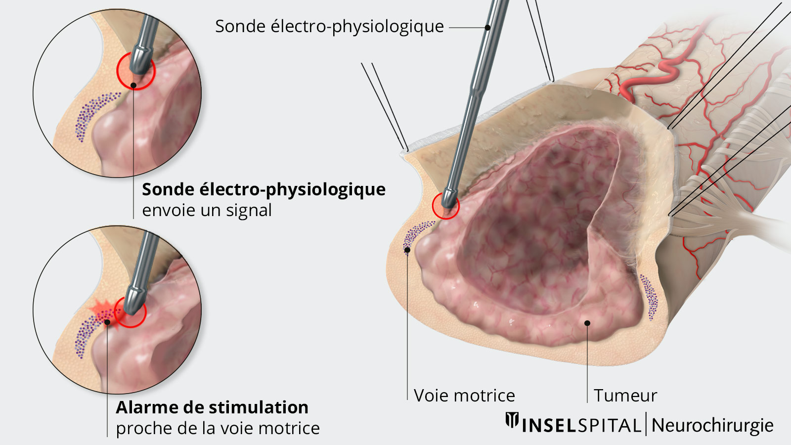 Représentation du mapping en 3 dessins partiels avec la tumeur, la voie motrice et la sonde de mapping qui donne l'alarme de stimulation à proximité de la voie motrice..