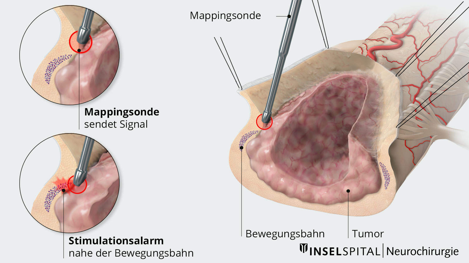 Dartellung des Mapping in 3 Teilzeichnungen mit Tumor, Bewegungsbahn und Mappingsonde, die in Nähe der Bahn Stimulationsalarm gibt.