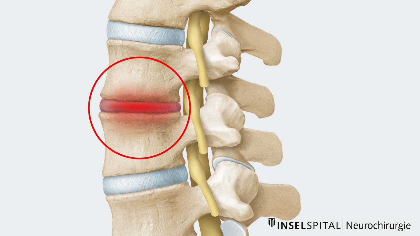 Drawing of an inflamed intervertebral disc with radiation to the neighboring vertebrae