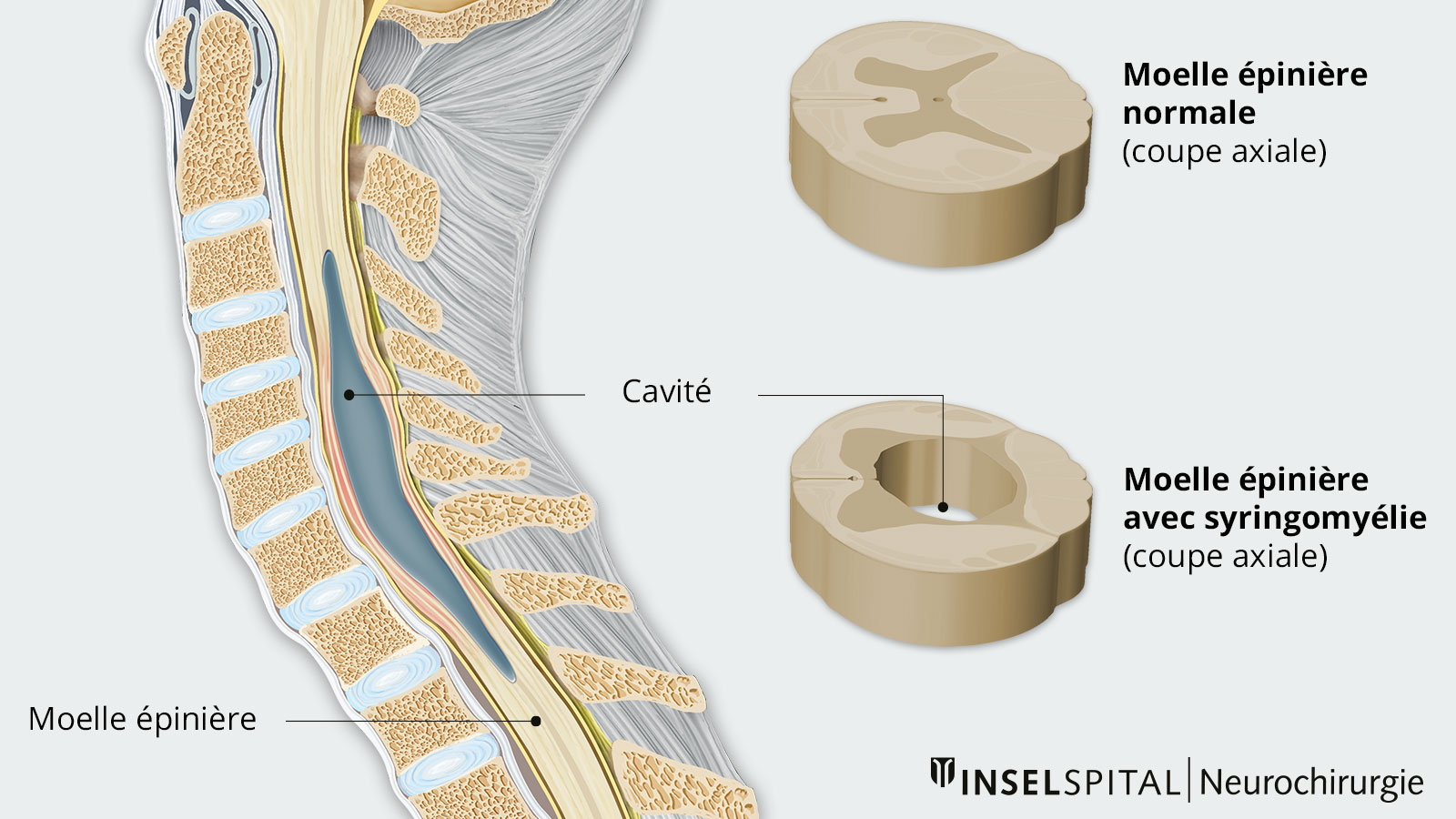 ​Dessin de la moelle épinière montrant la cavité déplaçant la moelle épinière. Dessins détaillés de la moelle épinière normale et de la moelle épinière dans la syringomyélie en coupe transversale.