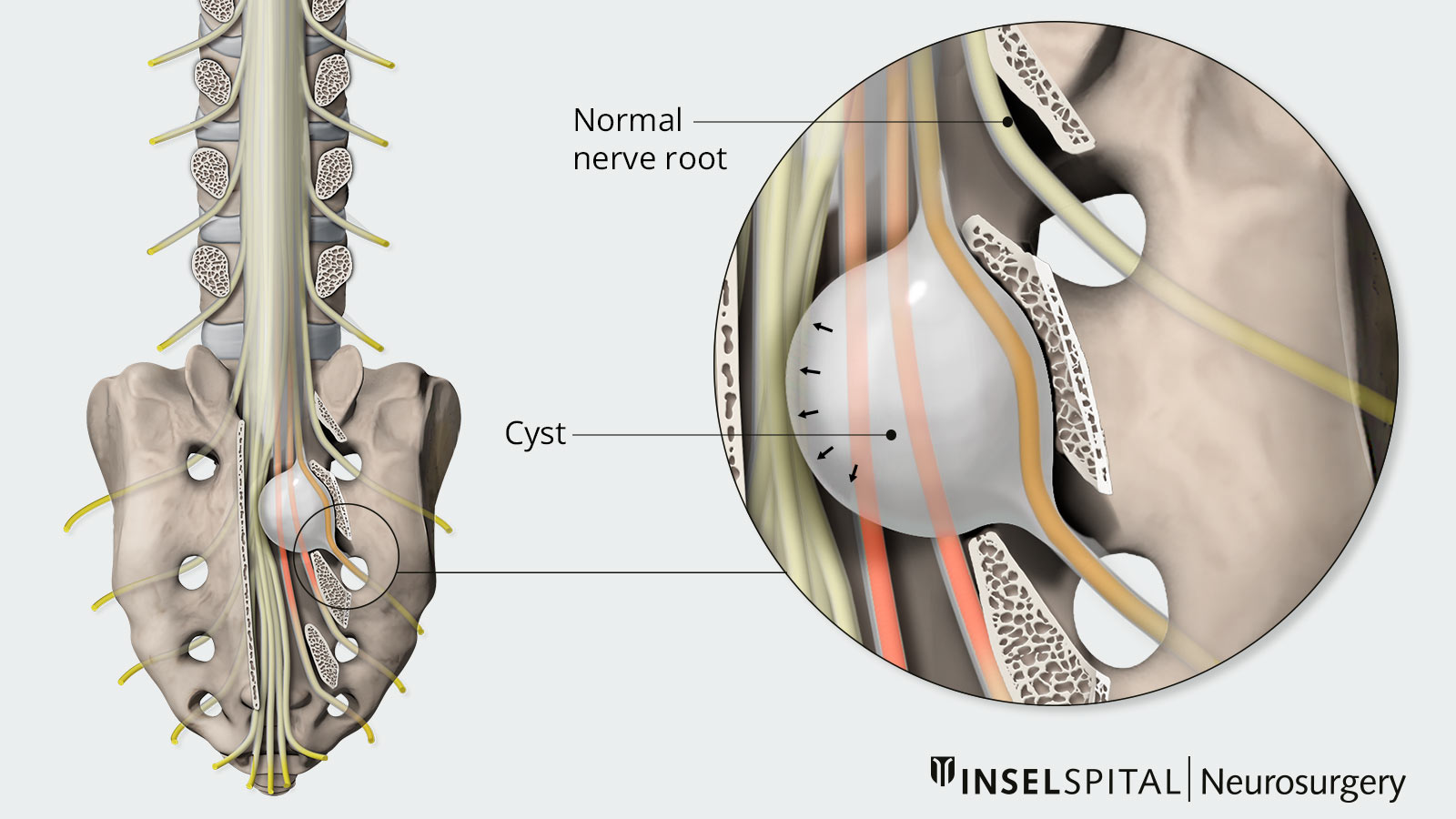 Drawing of a sacral Tarlov cyst with pressure effect (red) on surrounding nerve roots