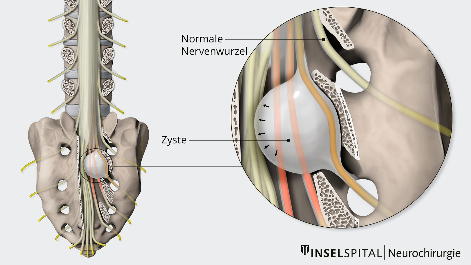 Zeichnung einer sakralen Tarlov-Zyste mit Druckwirkung (rot) auf umgebende Nervenwurzeln