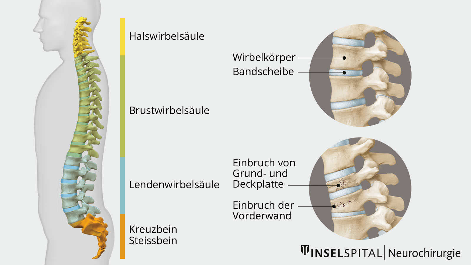 ​Zeichnung der kompletten Wirbelsäule in Seitenansicht. Unterschiedliche Wirbel sind unterschiedlich farbig markiert. In Detailansicht sieht man Wirbelkörper und Bandscheibe sowie 2 Arten der Wirbelfraktur.