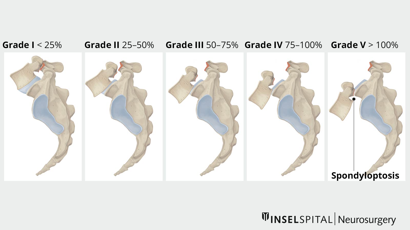 Meyerding classification (grades I-V)