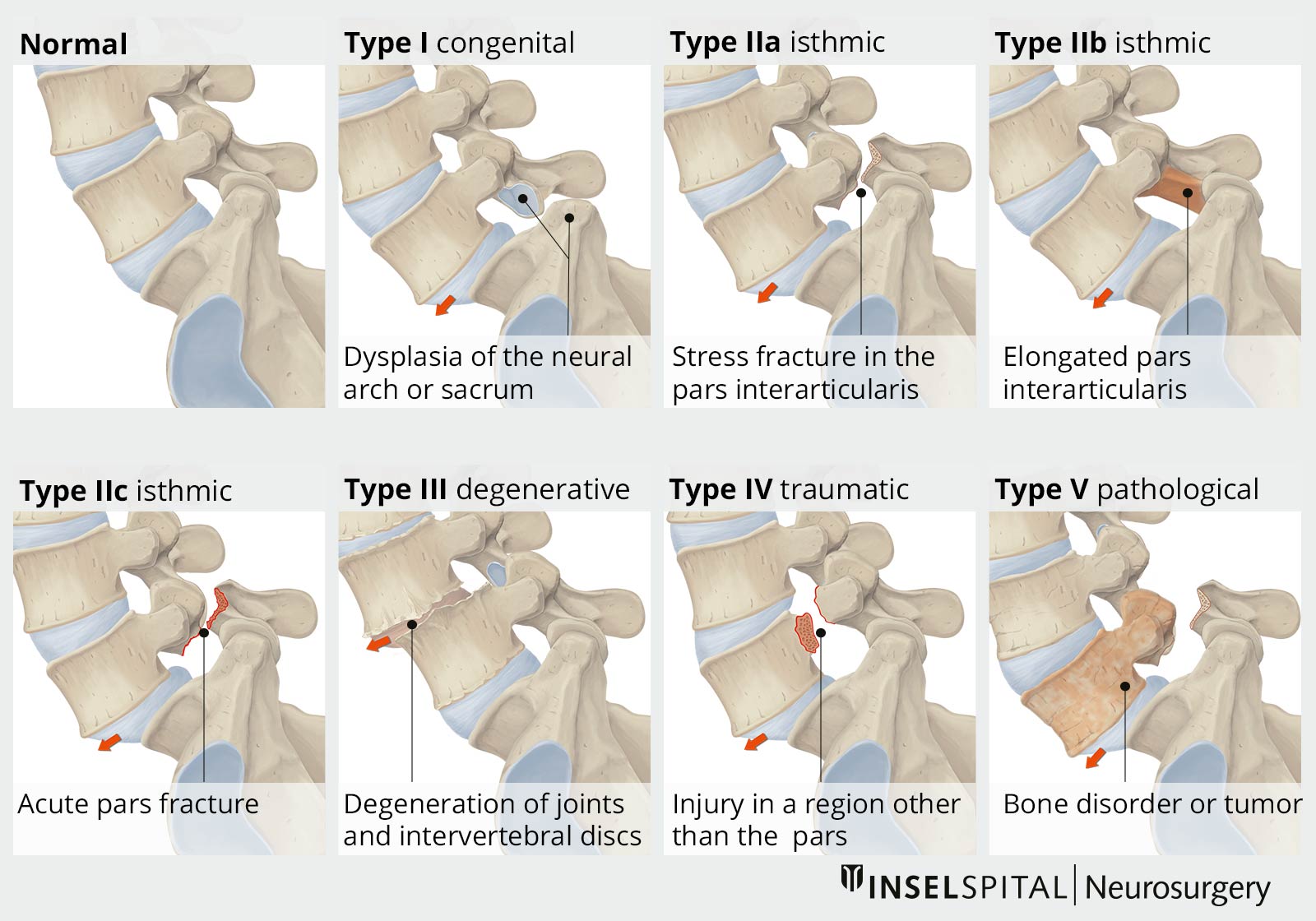 Image of the Wiltse classification (type I to type V)