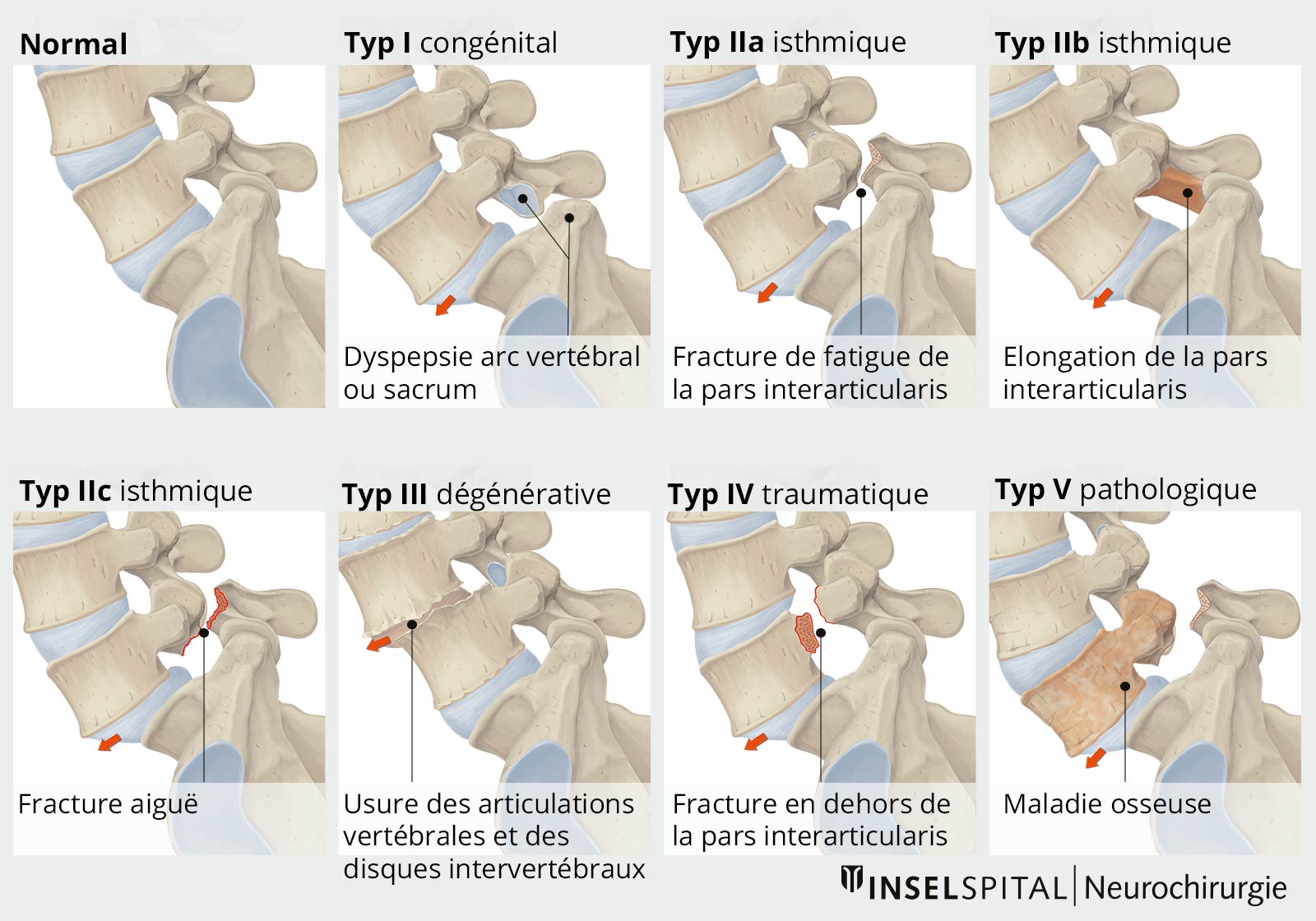 Représentation imagée de la classification de Wiltse (type I-type V)