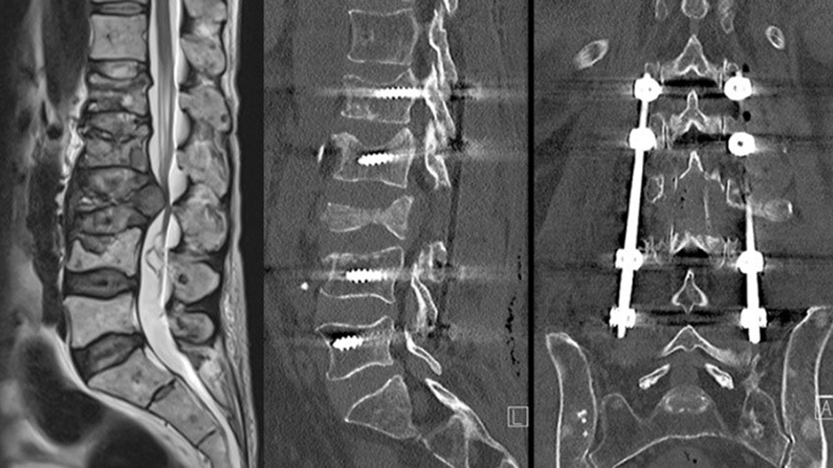 Bildaufname einer Wirbelkörpermetastase vor und nach Stabilisation und Laminektomie