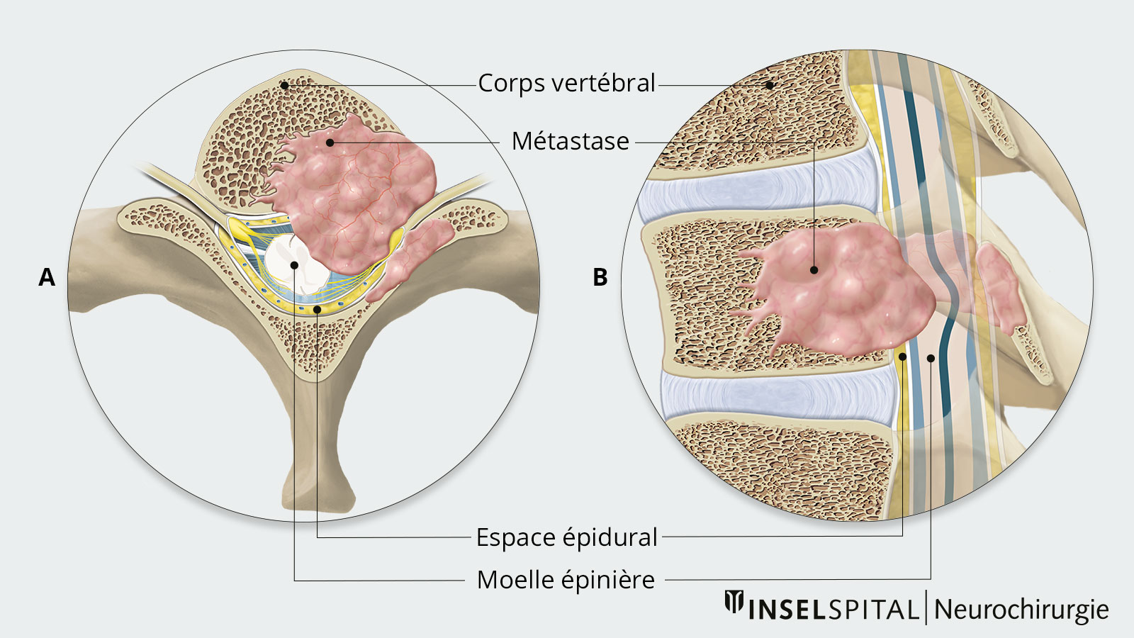 Dessin en coupe transversale du corps vertébral avec métastase clairement visible et compression de la moelle épinière