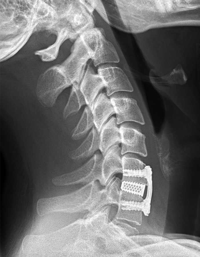 Radiographie après chirurgie avec insertion d'une cage