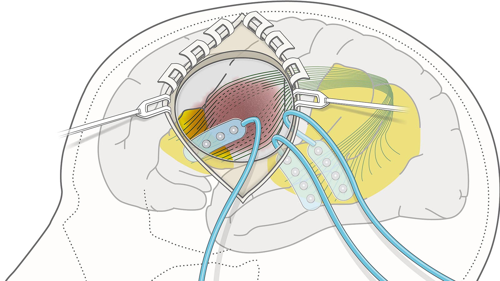 Schematische Darstellung einer minimalinvasiven Kraniotomie mit IONM