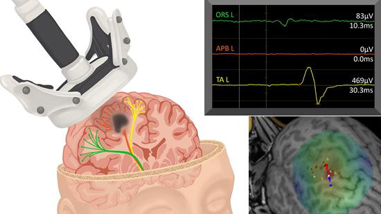 nTMS coil, MEPs, and nTMS map in patient MRI