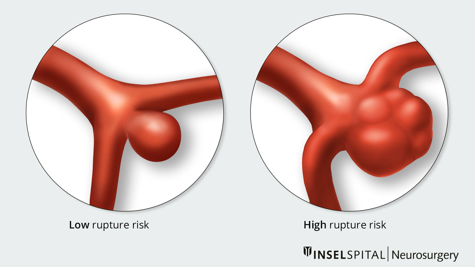 Drawing of two aneurysms with different risks of rupture