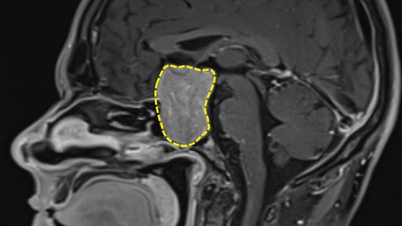 Makroadenom der Hypophyse
