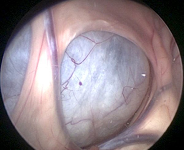 Vue d'un kyste arachnoïdien à travers la caméra de l'endoscope. 